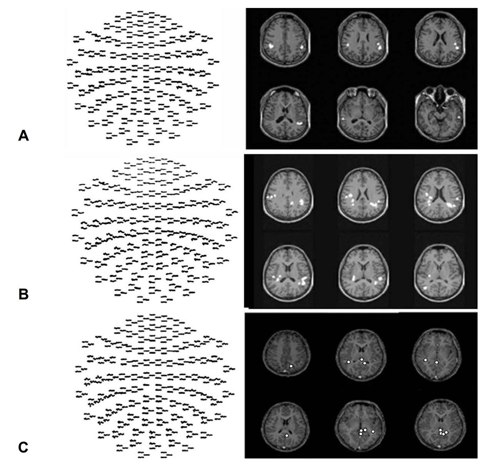 Language Lateralization Using Magnetoencephalography (MEG): A Preliminary Study